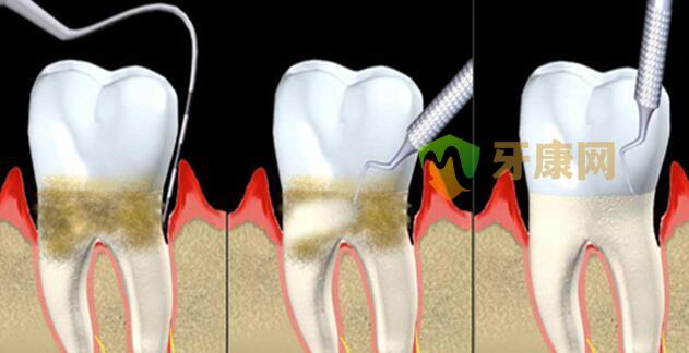 牙周病