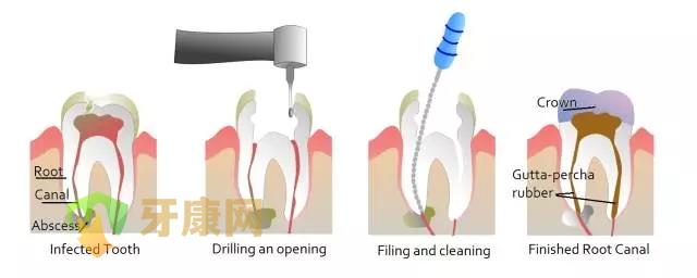 根管治疗