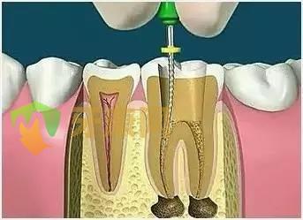 根管治疗