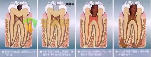 根管治疗