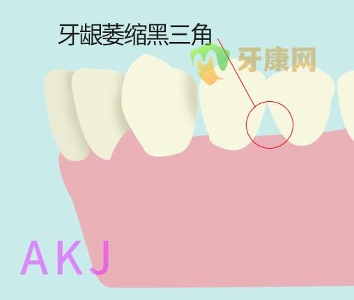 牙龈萎缩