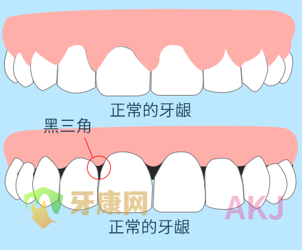 牙龈黑三角