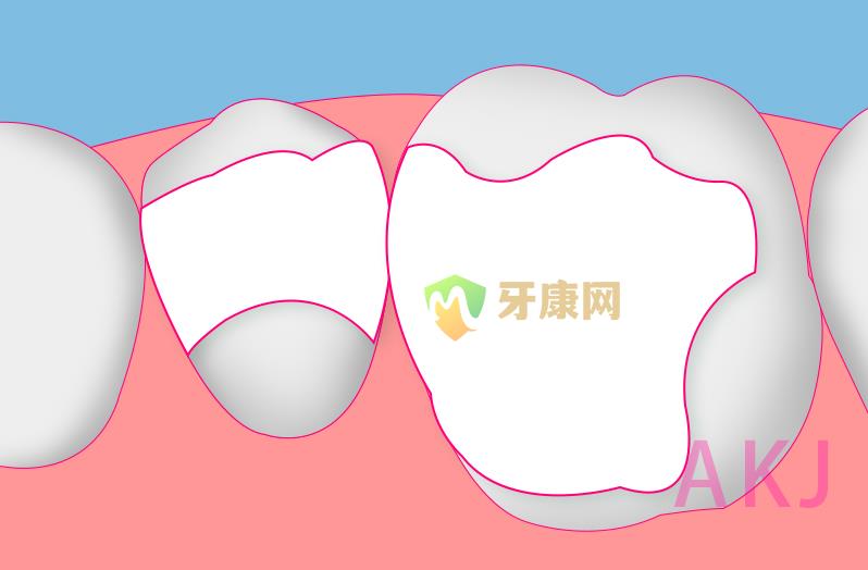 补牙材料