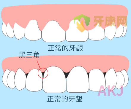 牙周炎