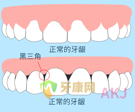 牙周炎