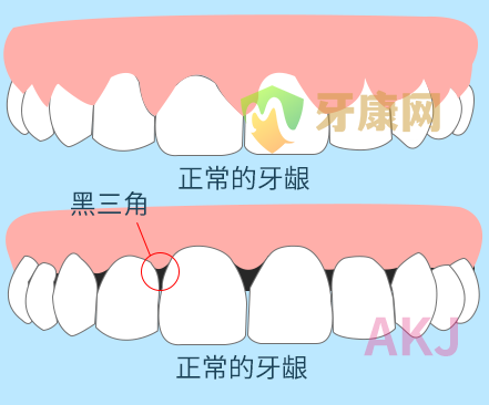 牙周病