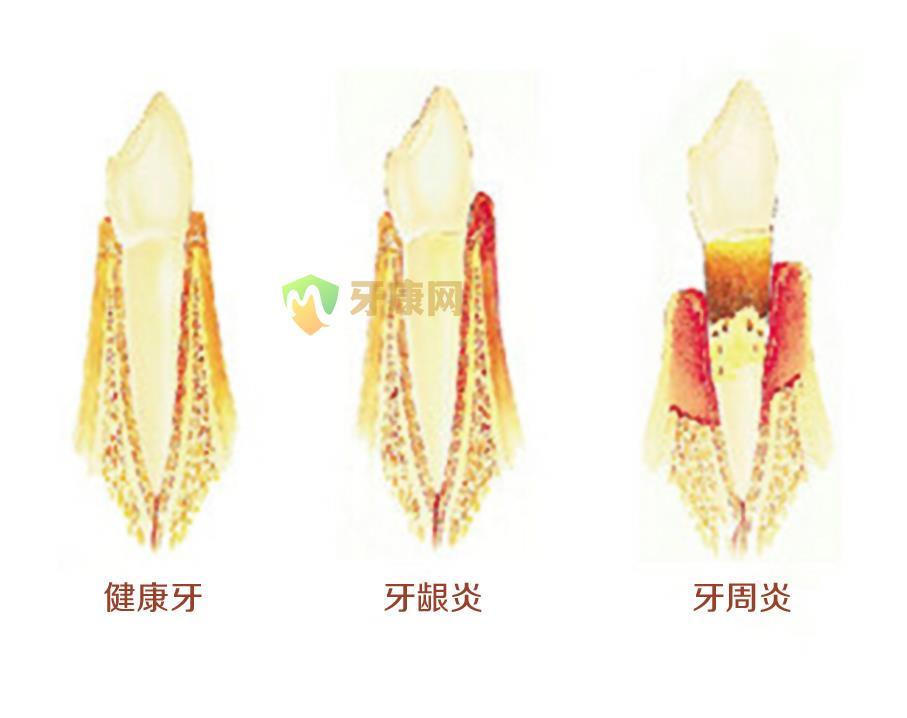 牙周炎