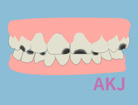 牙齿黑斑