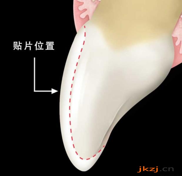 贴面磨牙量