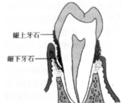 牙龈上和牙龈下的牙结石