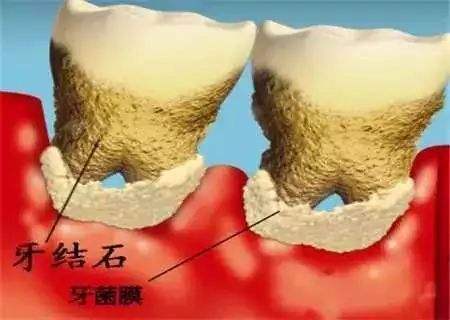 牙结石和牙菌斑