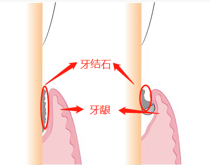 普通洗牙和深度洗牙