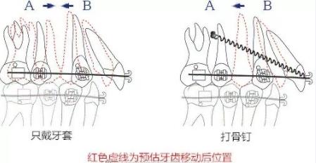 打骨钉和不打骨钉的牙齿移动情况