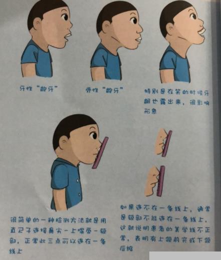 龅牙，牙性和骨性怎么看