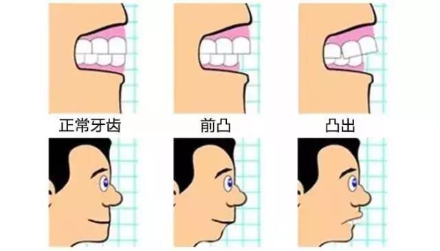 龅牙矫治是否需要拔牙