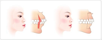 龅牙的矫正方法有哪些
