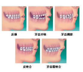 矫正龅牙要拔牙吗