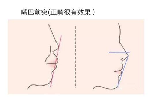 嘴凸正畸整形的大概费用是多少