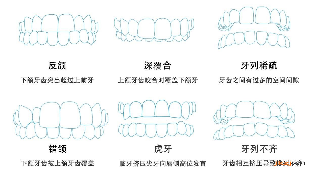 牙齿不齐的情况