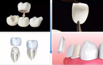 牙冠修复和贴面修复的区别