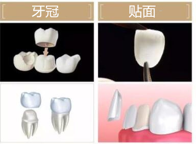 牙冠和贴面磨牙多少示意图