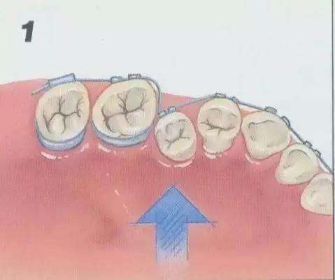 牙齿不齐矫正