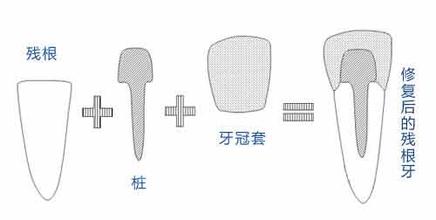 残根打桩修复示意图