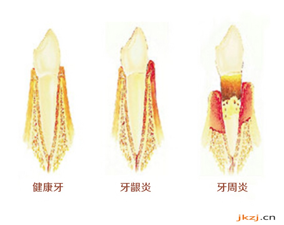 牙周病