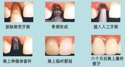种植牙过程