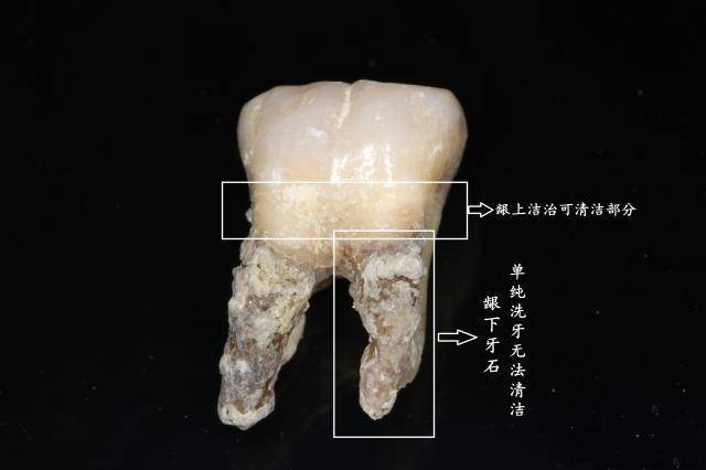 牙齿掉的快是什么原因