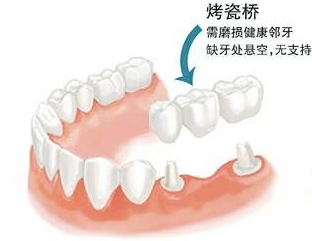 拔牙后镶牙还是种牙