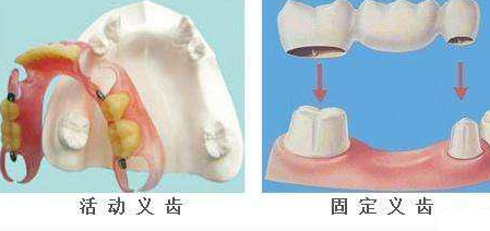 镶牙方式