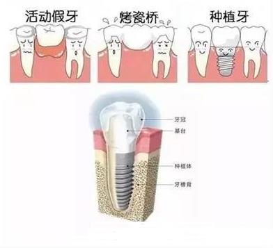 镶牙需要多久时间