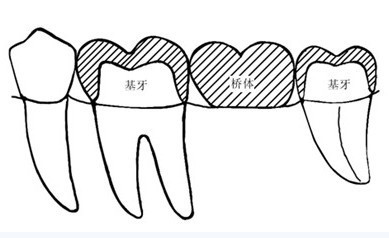 镶牙步骤