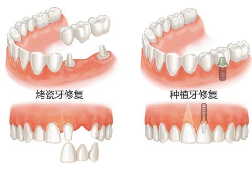 镶牙痛不痛