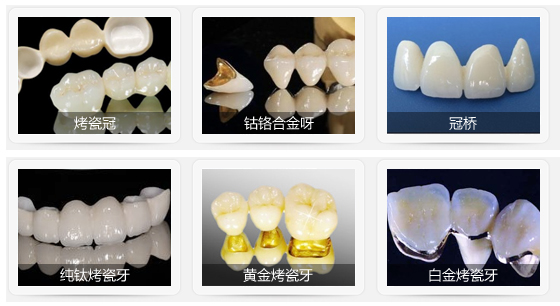 成人烤瓷牙一般价格