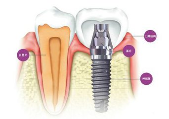 种植牙种一颗牙