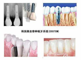 韩国奥齿泰种植牙修复结果