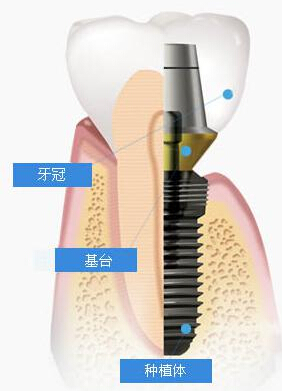 种植牙危害是什么