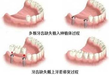 种植牙失败的表现