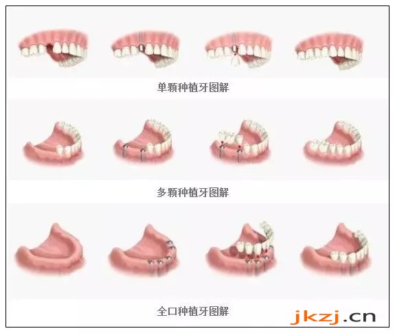 种牙几天拆线比较好