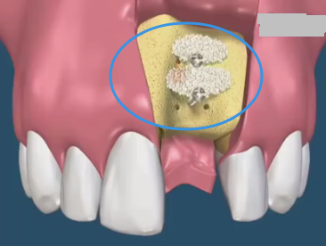 种植牙植骨粉费用