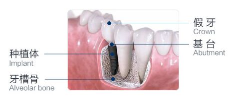 换一颗种植牙要多少钱