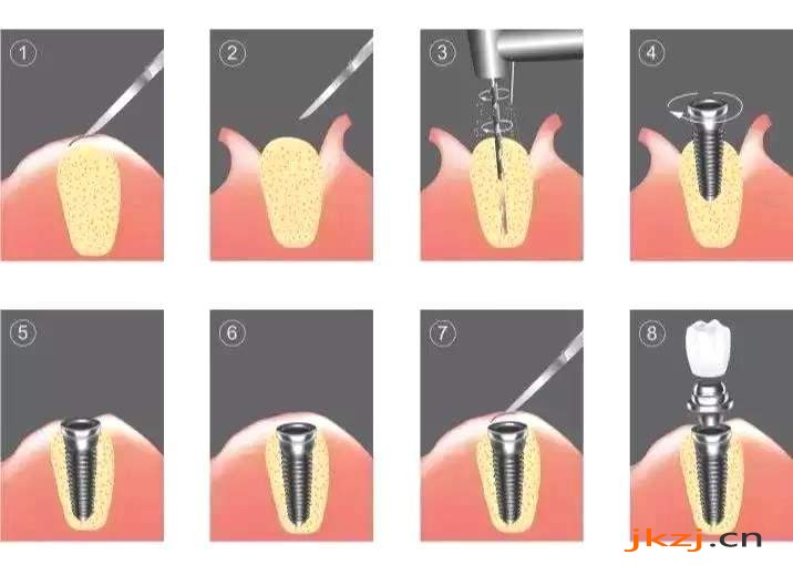种牙过程