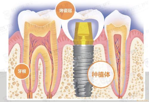 奥齿泰种植牙费用