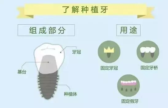 多颗牙种植价格