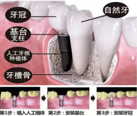 人工种植牙齿多少钱