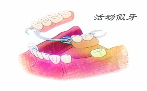 半口牙种植需要做几次手术