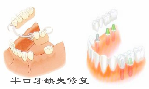 半口牙缺失为什么要做种植牙