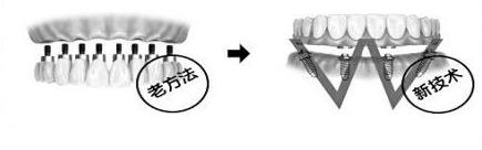 种植全口牙是怎么做的
